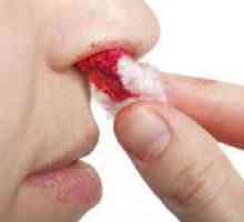 Mezi hlavní příčiny krvácení z nosu