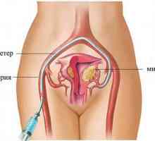 Děložní fibroidy (fibroidy) bez operace ve skutečnosti působí