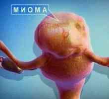 Děložní myomy - mazaný nepřítel žen