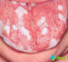 Afty na jazyku - signál problémů v těle
