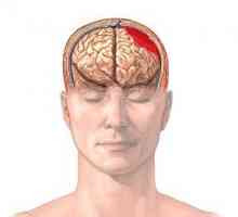 Mozkové hematom: typy, příčiny, příznaky, léčba, důsledky