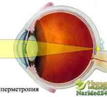 Lidové léčení očních chorob - hyperopia