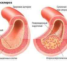 Lidové léky pro arteriosklerózy dolních končetin