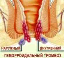 Externí trombóza hemoroidu a její léčba