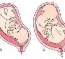 Low placenta previa