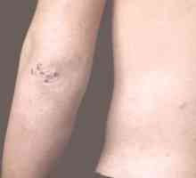Jaký signál skvrny na kolena a lokty?