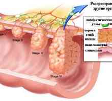 O příčinách rakoviny tlustého střeva
