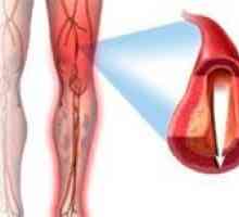 Ateroskleróza dolních končetin (nohy)