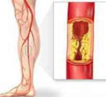 Ateroskleróza cévách nohou