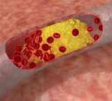 Přehled léků, které snižují hladinu cholesterolu v krvi