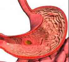 Fokální zánět žaludku - žaludeční sliznice poškozená plocha