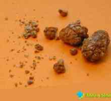 Oxalátové ledvinové kameny: symptomy a příčiny, léčba, prevence