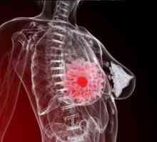 Oleogranulema - zánětlivé nádor prsu