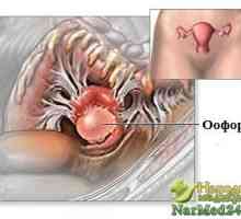 Oophoritis - vážnou hrozbou pro zdraví žen