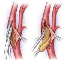 Chirurgické odstranění plaky cholesterolu při ateroskleróze (karotické endarterektomii)