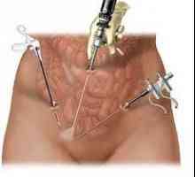 Chirurgické odstranění dělohy fibroids