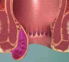 Komplikace hemoroidů - žilní trombóza a flebitida: znaky, procedury, efekty