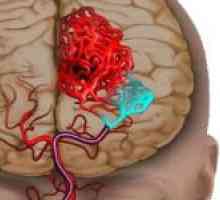 Hlavními příznaky ischemické cévní mozkové příhodě