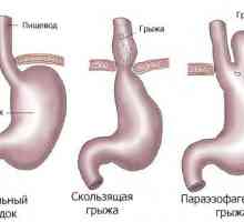 Hlavní metody léčení kýly žaludek