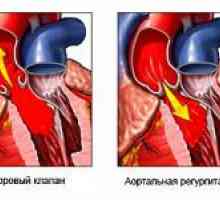 Rysy aortální nedostatečnost a její stupeň