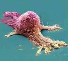 Diagnostika a léčba rakoviny prsu Paget