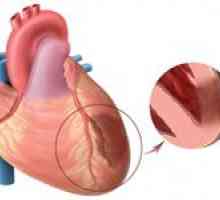 Nabízí transmurální infarkt myokardu a jeho léčba