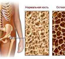 Osteoporóza - hlavní příčinou zlomenin