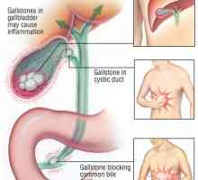 Akutní cholecystitida - infekce žlučových cest