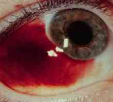 Proč jsou rozbité cévy v očích