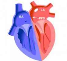Foramen ovale (otvory) v srdci, způsobí uzavření prognózy