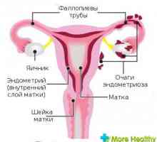 Endometrióza 1 stupeň
