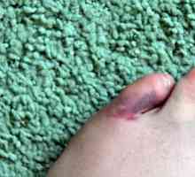 Zlomenina malíčku na noze: příznaky a léčba