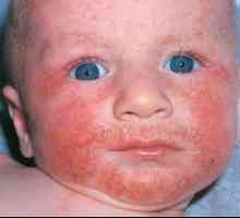 Potravinové alergie u dětí