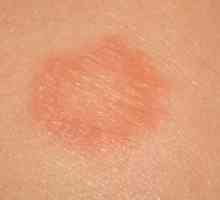 Skvrny na kůži, jako je popálení: Možné příčiny