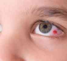 Hlavními důvody pro prasknutí cévy v očích