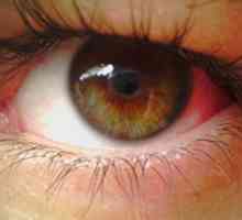 Proč praskla kapilár v očích? Příčiny a prevence