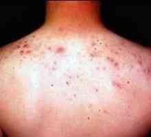Co způsobuje akné na zádech a ramenou?