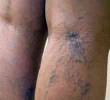 Proč modřiny na nohách bezdůvodně u žen? Křehké kloubů, onemocnění krve.