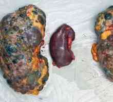 Multicystická onemocnění ledvin