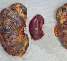 Co je polycystické onemocnění ledvin? Existují způsoby, jak zotavení