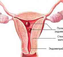 Polypy endometria