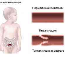 Následky střevní obstrukce u kojenců