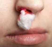 Příčiny časté krvácení z nosu a způsoby zastavení