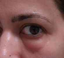 Příčiny a léčba oteklé oči
