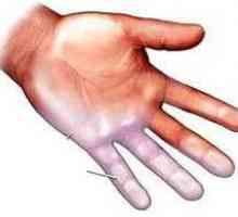Příčiny necitlivosti prstů a léčby