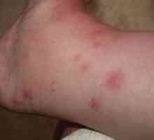 Příčiny edému v alergie a jak je řešit