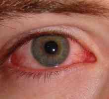 Příčiny a léčba alergické oční edém