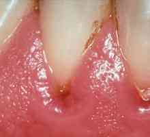 Příčiny a léčba dásní absces
