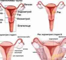 Příčiny a léčba hyperplazie endometria dělohy