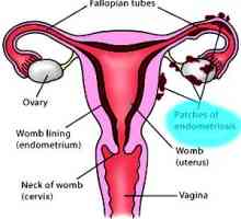 Příčiny endometriózy, děložní - zvážit všechny teorie